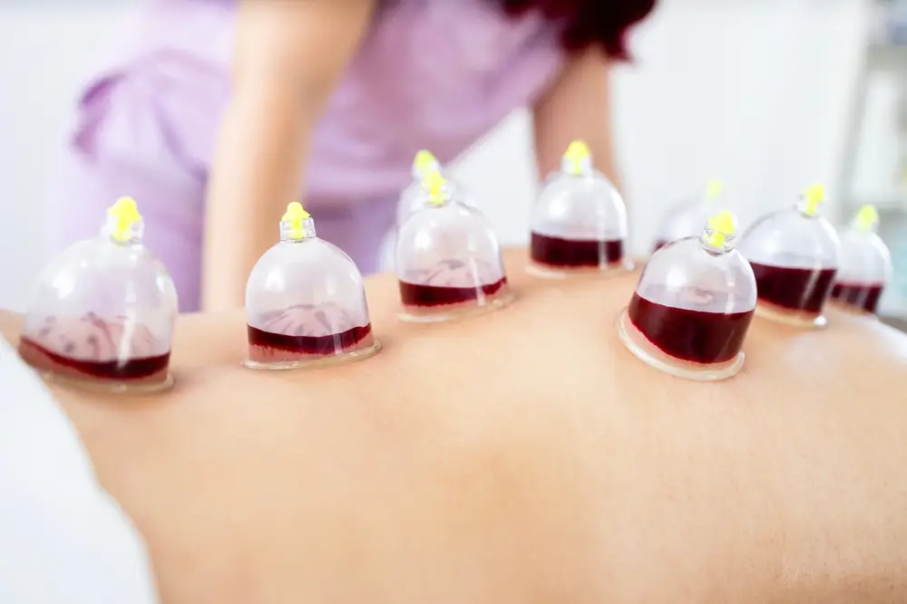 How Hijama Cupping Works