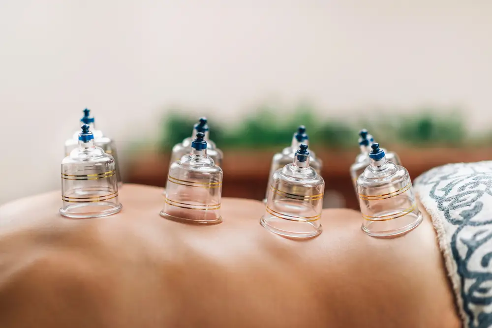 Hijama Therapy for Pain Relief